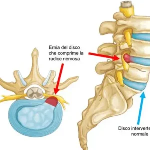 ernia discale ernia discale