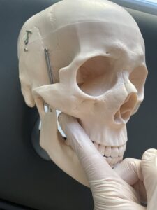 pterigoideo laterale