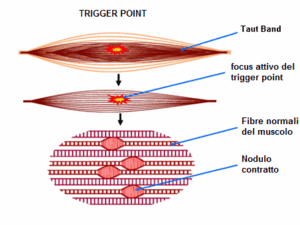 trigger point