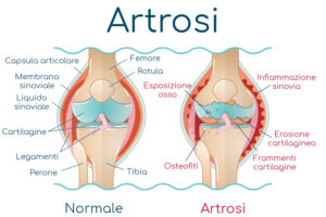 artrosi