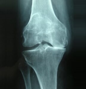 rx artrosi radiografia artrosi