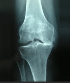 radiografia artrosi