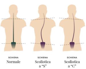 tipologie scoliosi